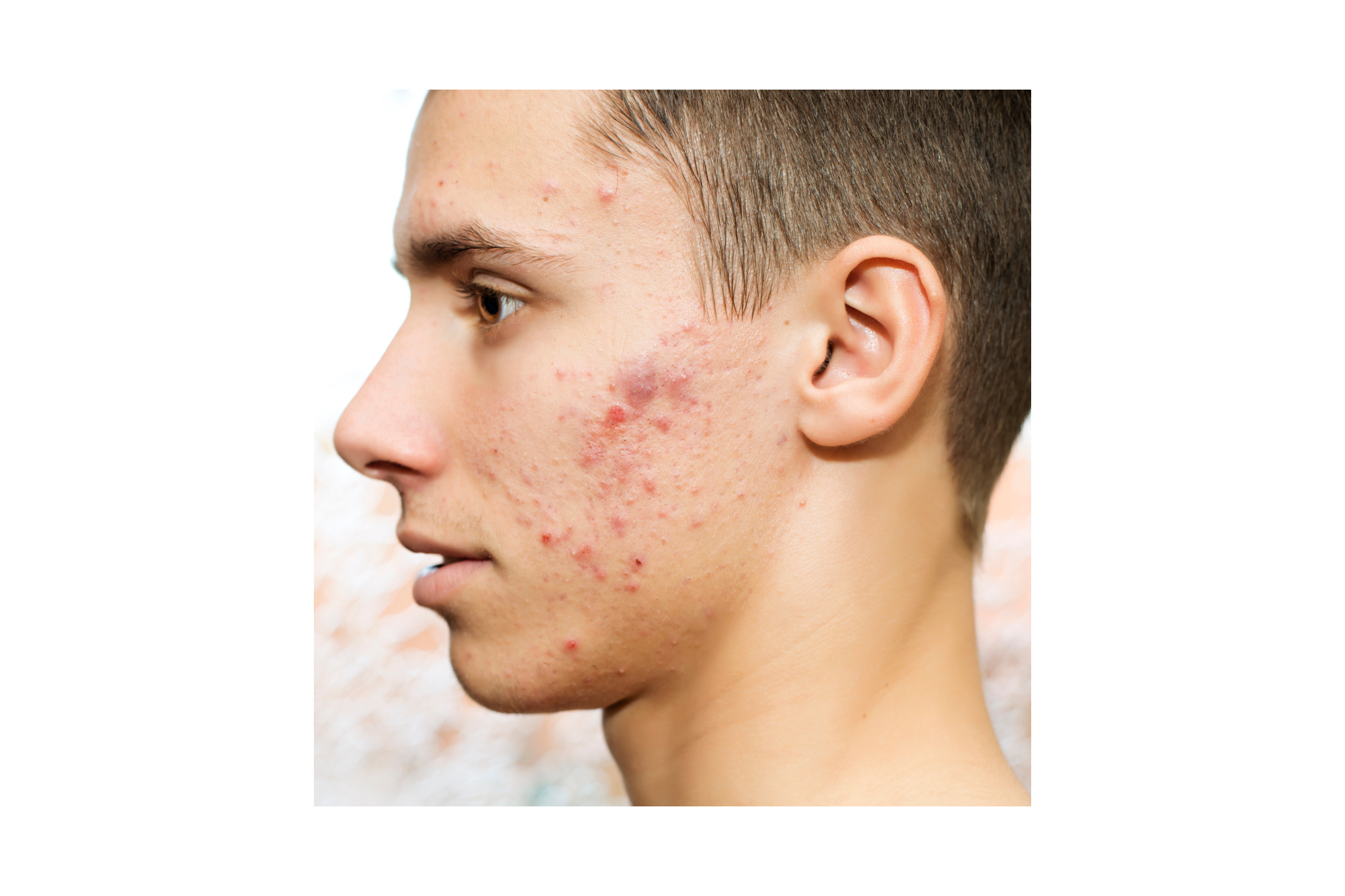 Can aftershave help treat acne?