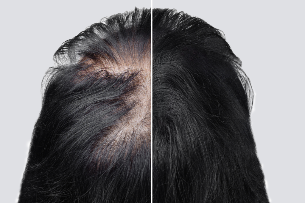 Are you at risk for alopecia areata