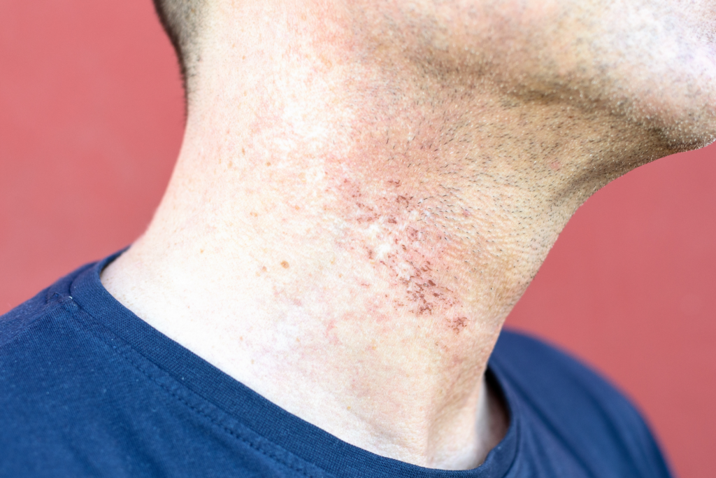 skin irritation caused by a dirty beard